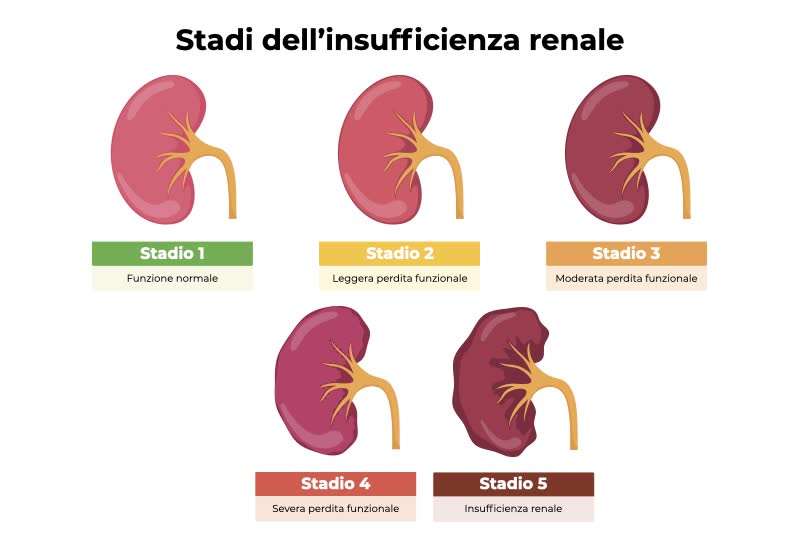 Infografica che descrive i 5 stadi dell’ insufficienza renale